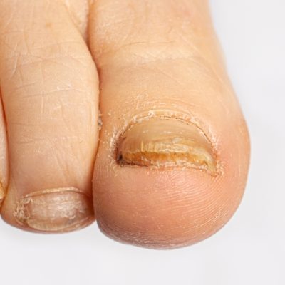 Fungus of nails on the big toe - dermatomycosis and onychomycosis, fungal infection macro photo. SSUCv3H4sIAAAAAAAACnRUy47bIBTdV+o/RKwb1Rhswiy76qZq96MuMJCYDjYW4KmqKP9esA3BUWZnzj333Levnz8dDqBjTnHwcrjGV3grrWfnLfPKjAGuvmy4laOQtkTeLWqrEpBCeWMV0yXYMc/7kQ0ygOOsdYRvixE4z/zspCuiu372XlrnDX8LMEoqsEb2HACYZdVlIU298aZkMmE6mfwzXVjJBufVkkZGORt3ItnANBv+lcBgnF9YbqcqJ+PUE8NkRtFEoKiWMy8voT27elP3X9f3IRm29Hwwge+Sad9zZuXXH6HFPPR3i7O2bO4i62f3R3LvQLKsUT+Q/CXNpOUzmW+sixlmlfXjd27MRY48duZ6K0qzUku2DvJ1pYK3v2GMw1LqRmKzUKYo/d2ESiIBFUqTVVyNl8LN+H5Zu+TGzTx6G1MAKX+gjZlYFwp6OZyDpkx4z5wLdJHwchphyc1QxBmNXwrYVIEI44pPiGqKKG1w1UCMW1QRUG5vr4LOkk5KcJ60YULGoLnzj3sN26olqG5onUdwX/Fkw3fb47ZnDrlz9oufCKc7YX8DK6Gt0qE+O4eNA9Nel5eRbEUG+yPZCHVTZPB4LxsHFVnm02nr4AxJS1ZT2ue4qIMKzdw3+HmHUFXRu/TTIaAKtVuE3a8pcJTYnepDBIAoqWuKCcx7+BAAwFOLa0wIrpaD2rRVzBzABrKmEeiIWk6OmND2eMIneqSMY1ifKT9RGLxu/wEAAP//AwDLQTLMpgUAAA==